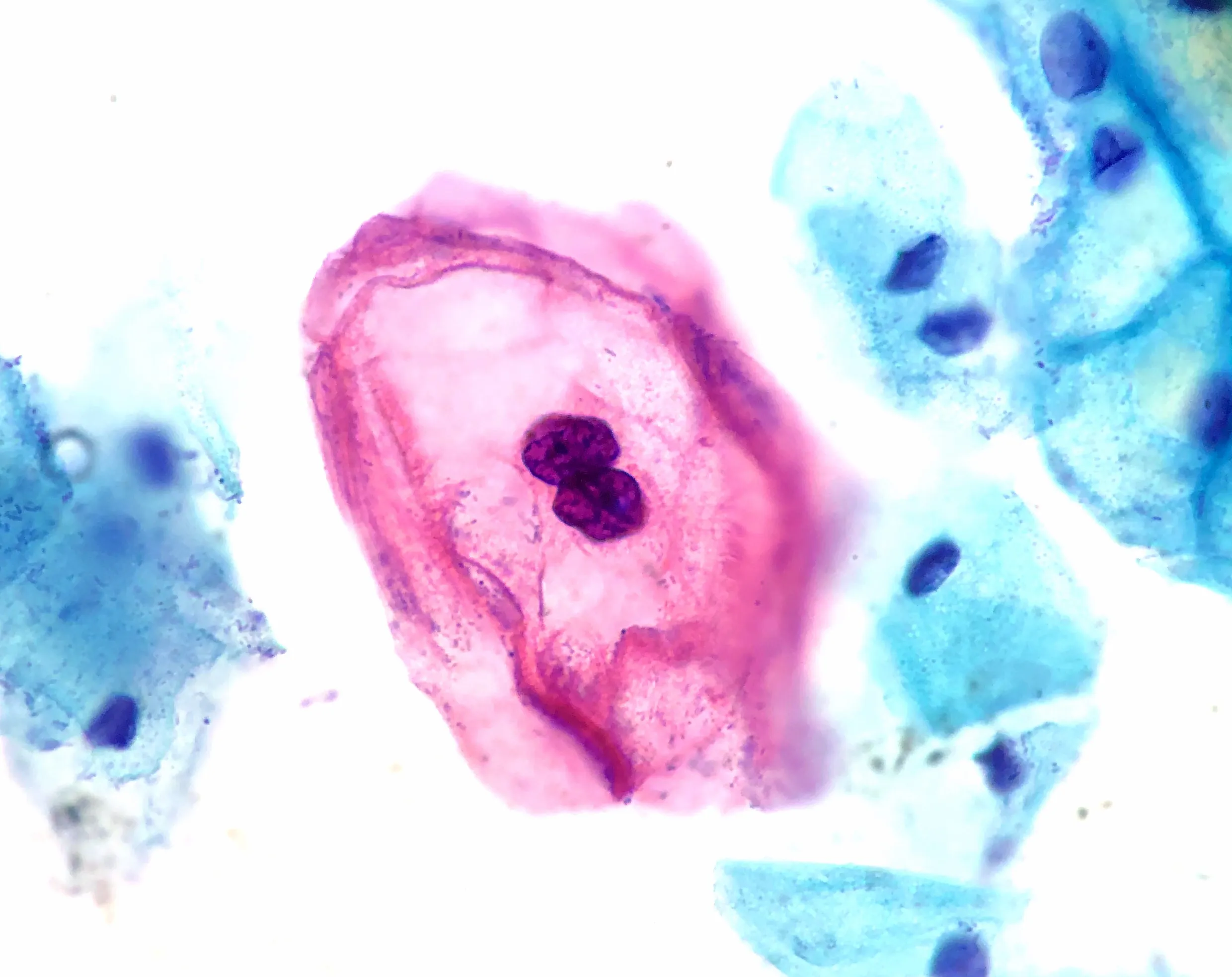 Pap smear micrograph showing cervical cells changed by HPV
