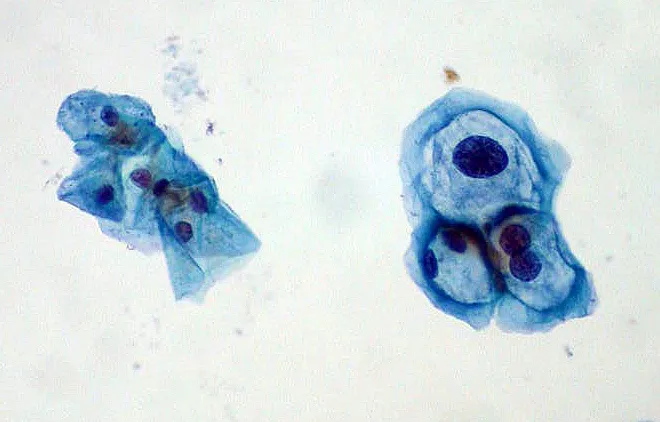 Cervical cells from a Pap test showing HPV-related changes, seen under the microscope
