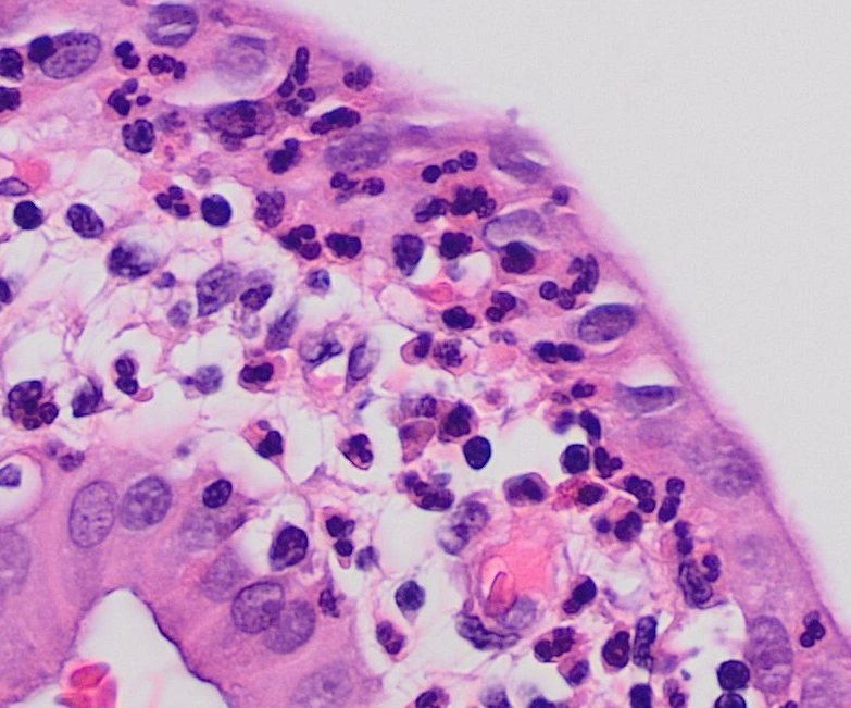 H&E micrograph of acute cholecystitis with neutrophils in the gallbladder wall