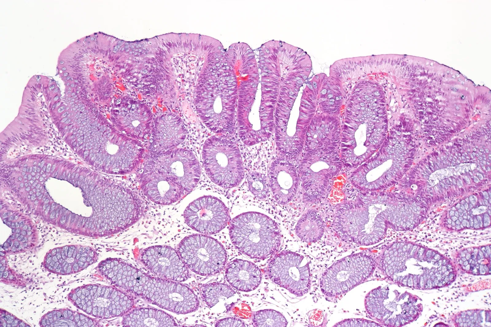 Tubular adenoma of the colon under the microscope, next to normal mucosa, hematoxylin and eosin stain