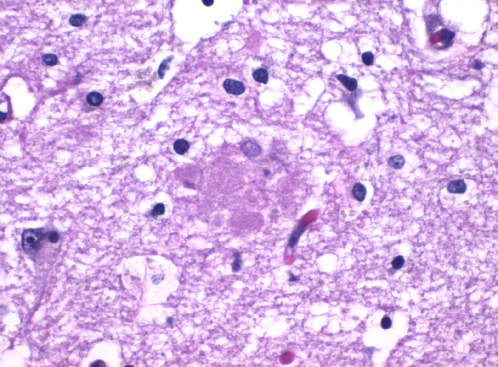 H&E micrograph of a beta-amyloid plaque in a hippocampus with Alzheimer’s disease