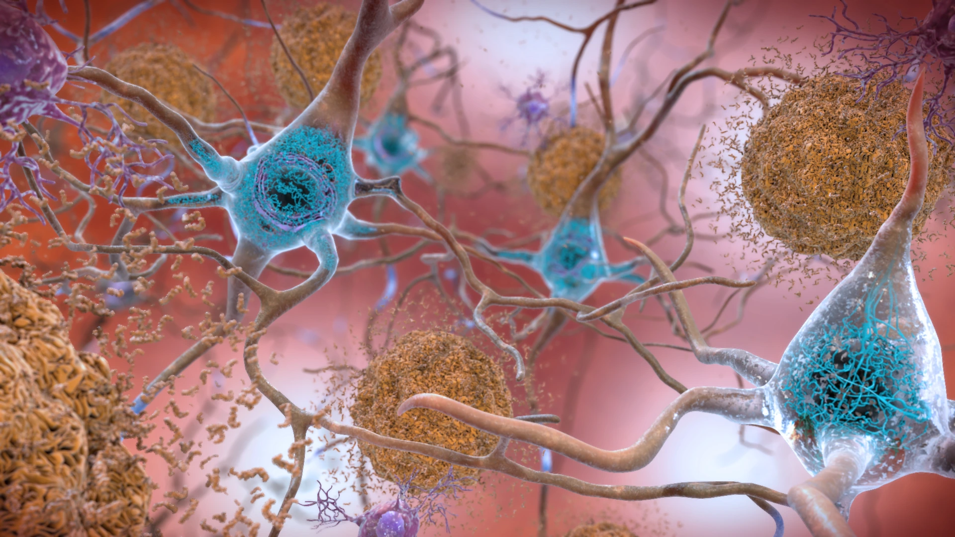 Illustration of beta-amyloid plaques between neurons and tau tangles inside them