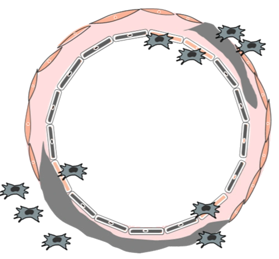 Spiral artery in a healthy pregnancy: a wide channel and a thin wall, with fibrinoid material and placental cells