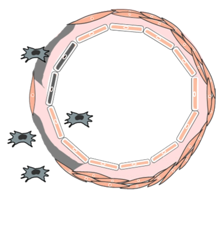 Spiral artery in preeclampsia: a narrower channel and a wall that keeps its muscle, with placental cells stuck on the outside