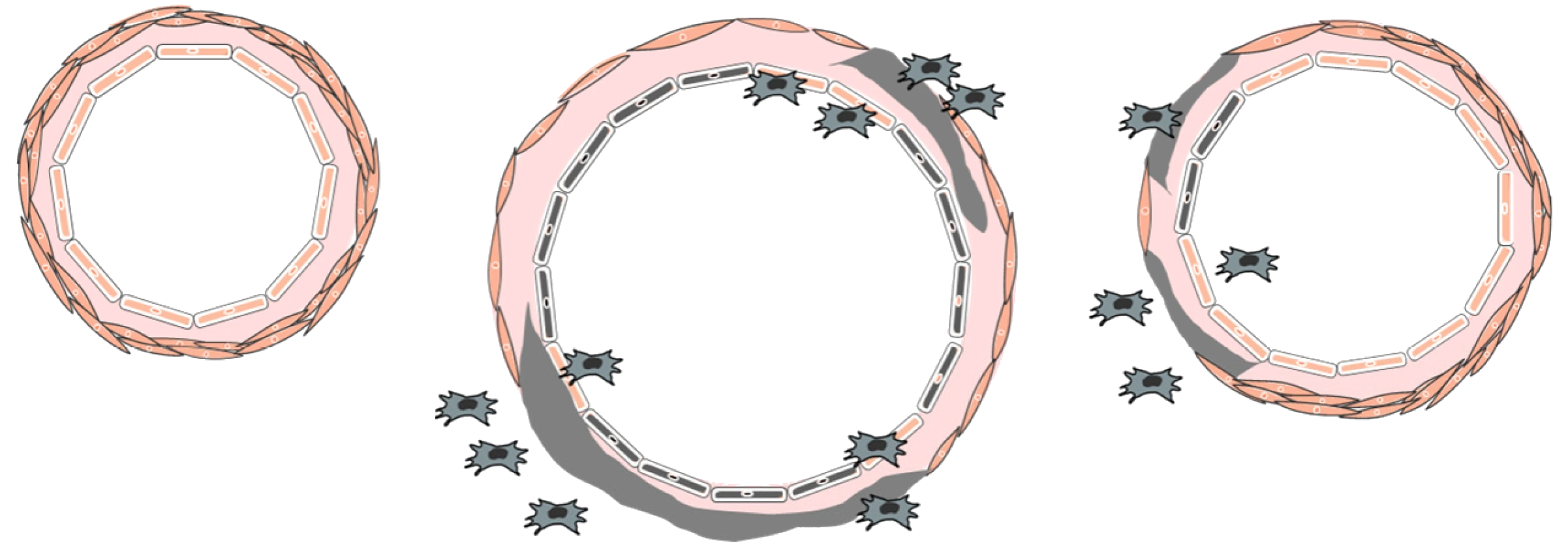 Three cross-sections of a spiral artery side by side in one diagram: before pregnancy, in a healthy pregnancy and in preeclampsia