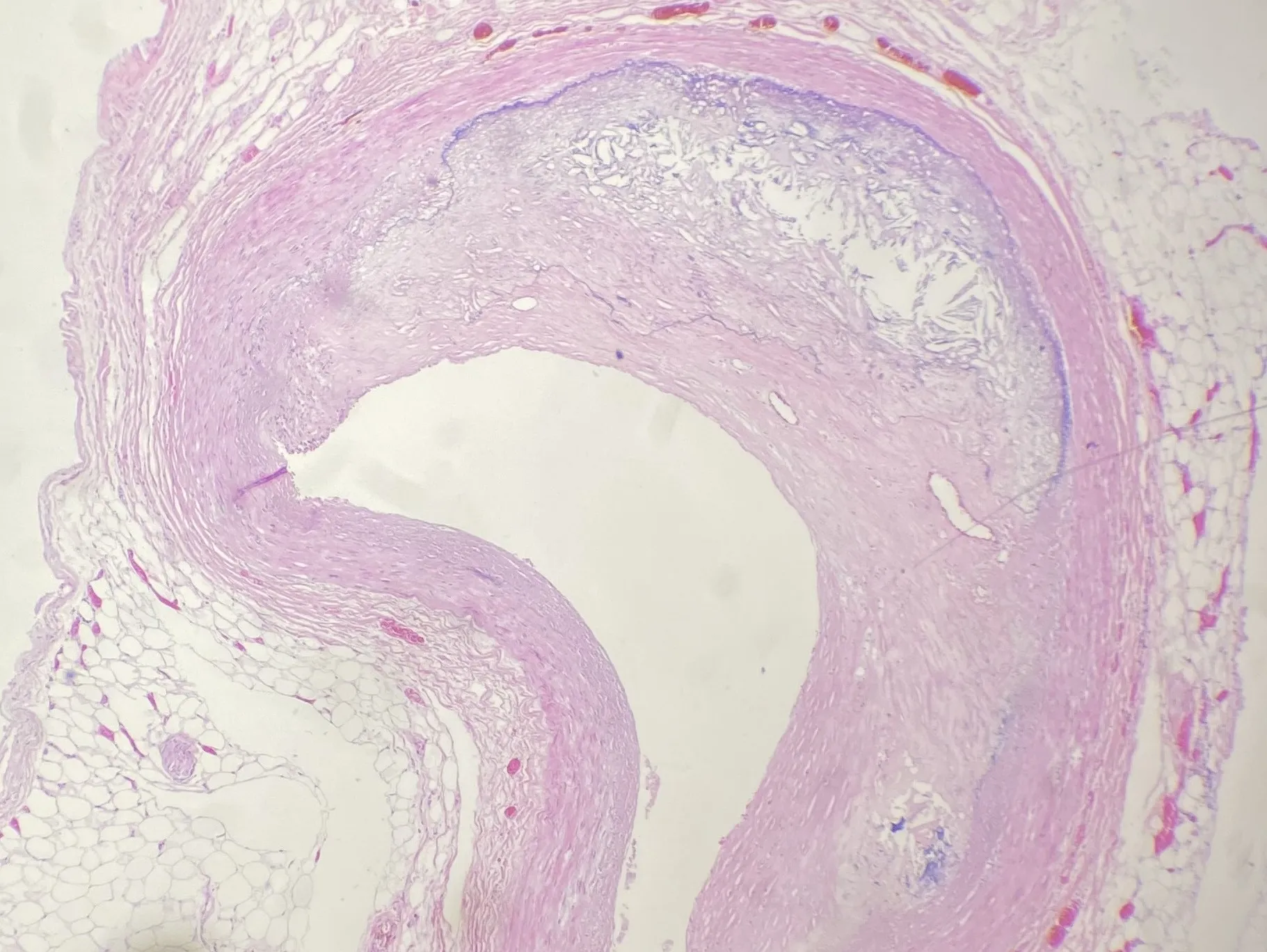 Microscope view of an artery wall thickened by a cholesterol-rich atherosclerotic plaque