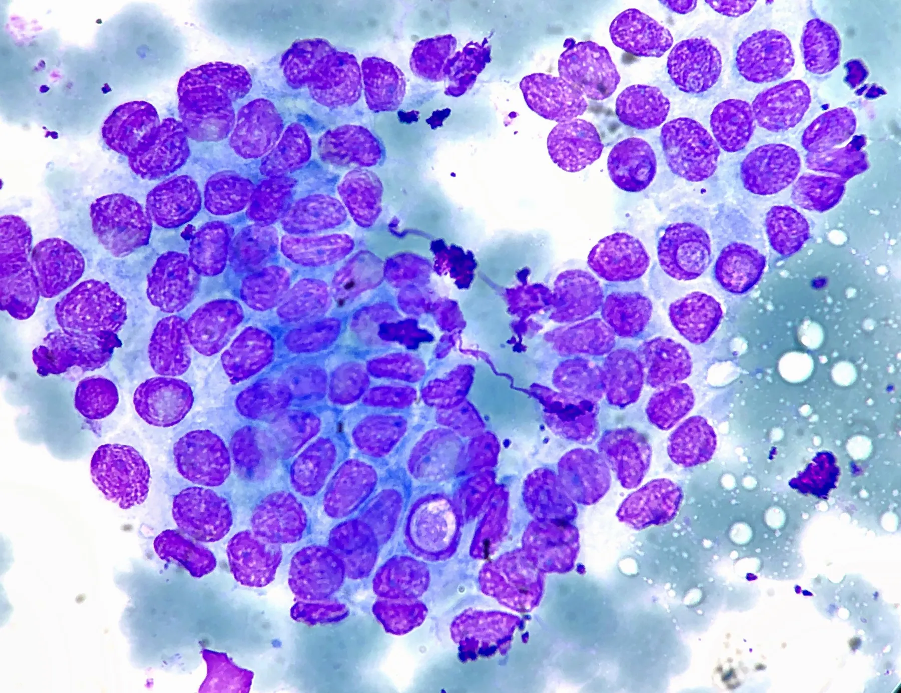 Fine needle biopsy cytology of papillary thyroid carcinoma, with clusters of thyroid follicular cells