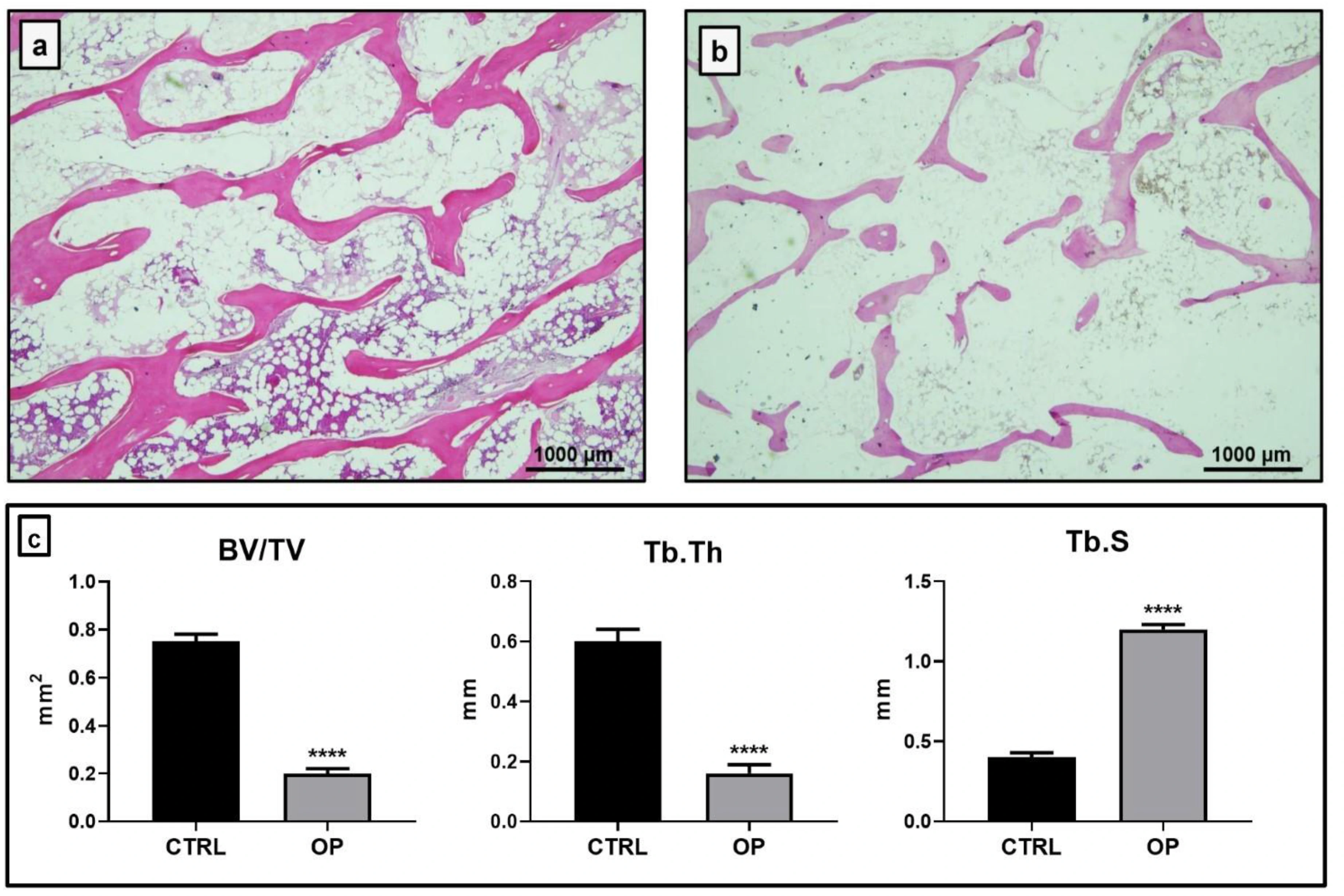 Human trabecular bone without osteoporosis, with thick connected trabeculae