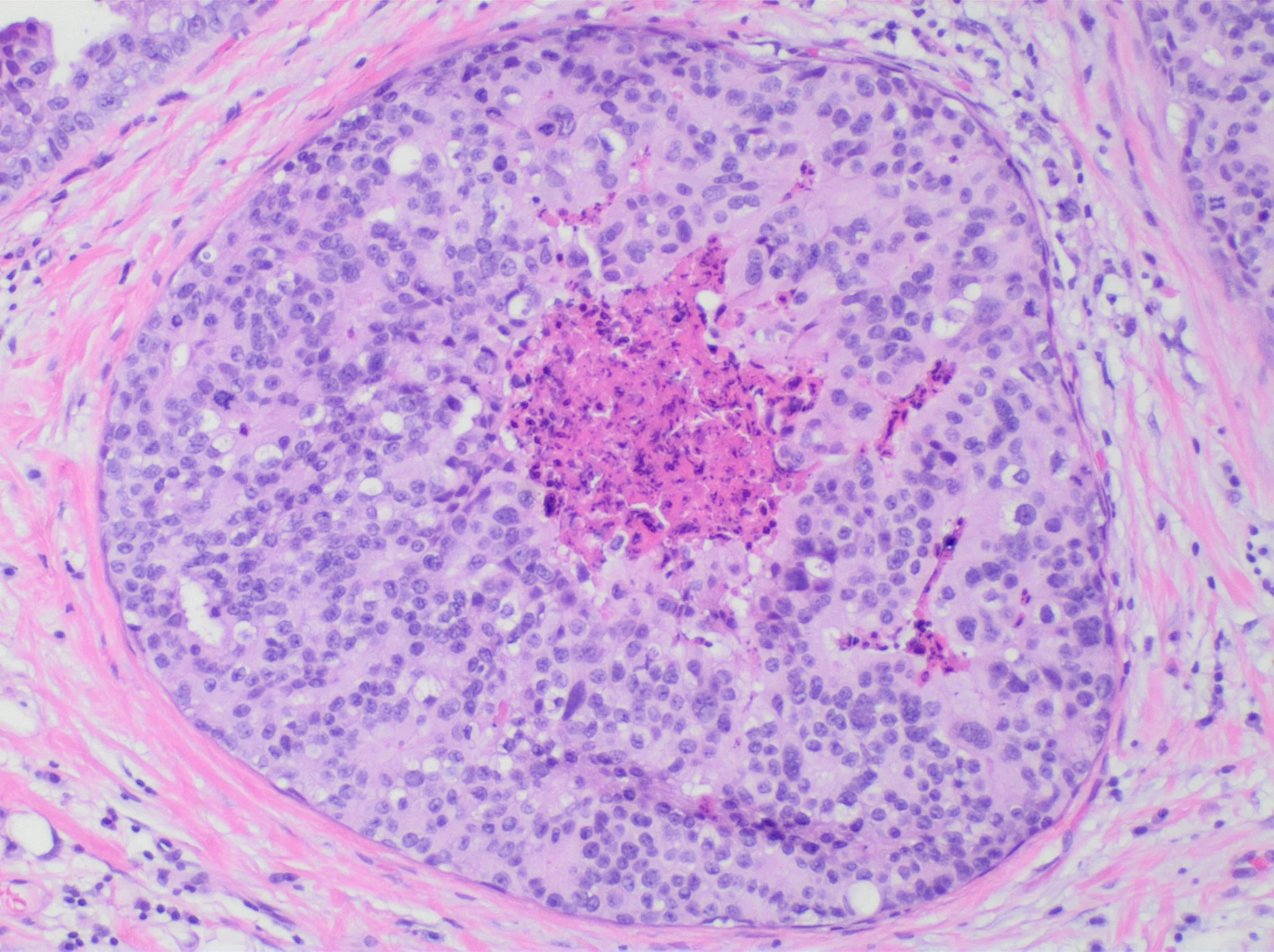 H&E micrograph of a breast duct filled by ductal carcinoma in situ