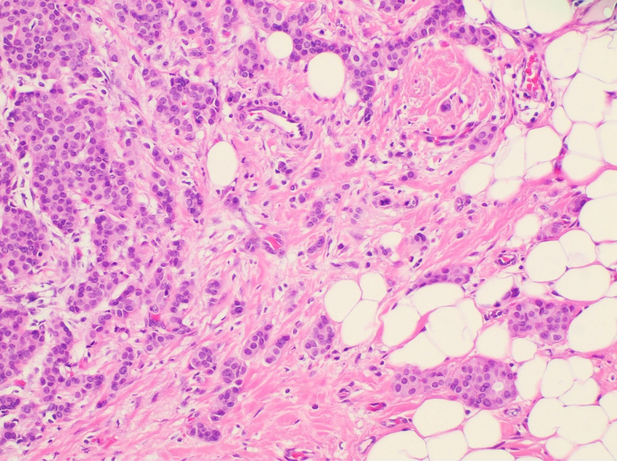 H&E micrograph of invasive ductal carcinoma with groups of cells scattered through breast tissue