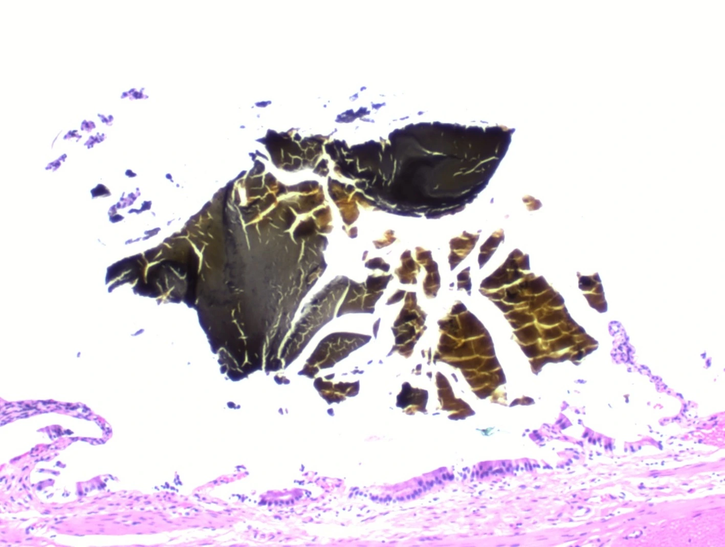 H&E micrograph of cholelithiasis with stone fragments along the gallbladder lining