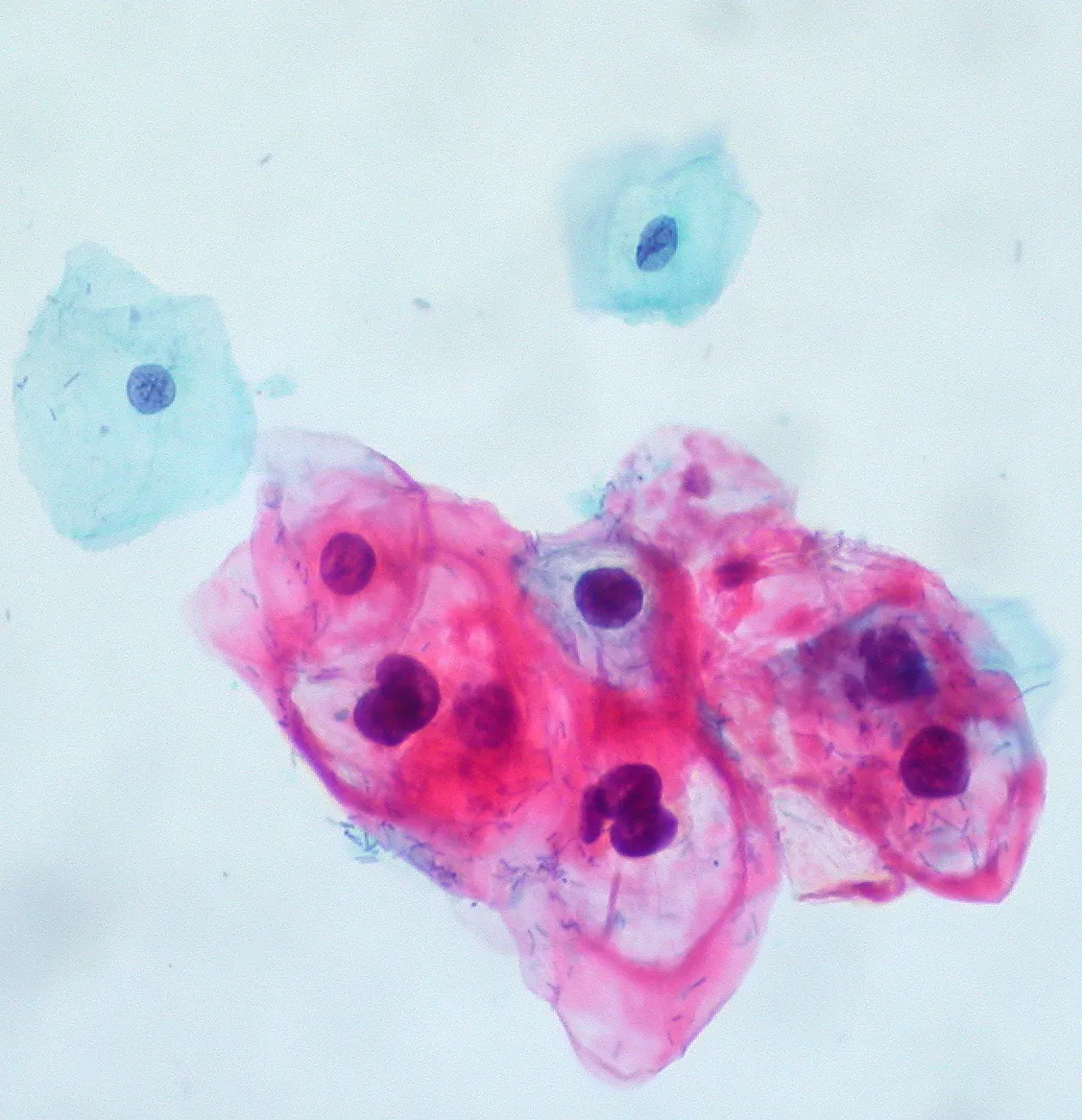 Cervical cytology under the microscope: a cluster of cells with a clear hollow around the nucleus, next to two normal squamous cells