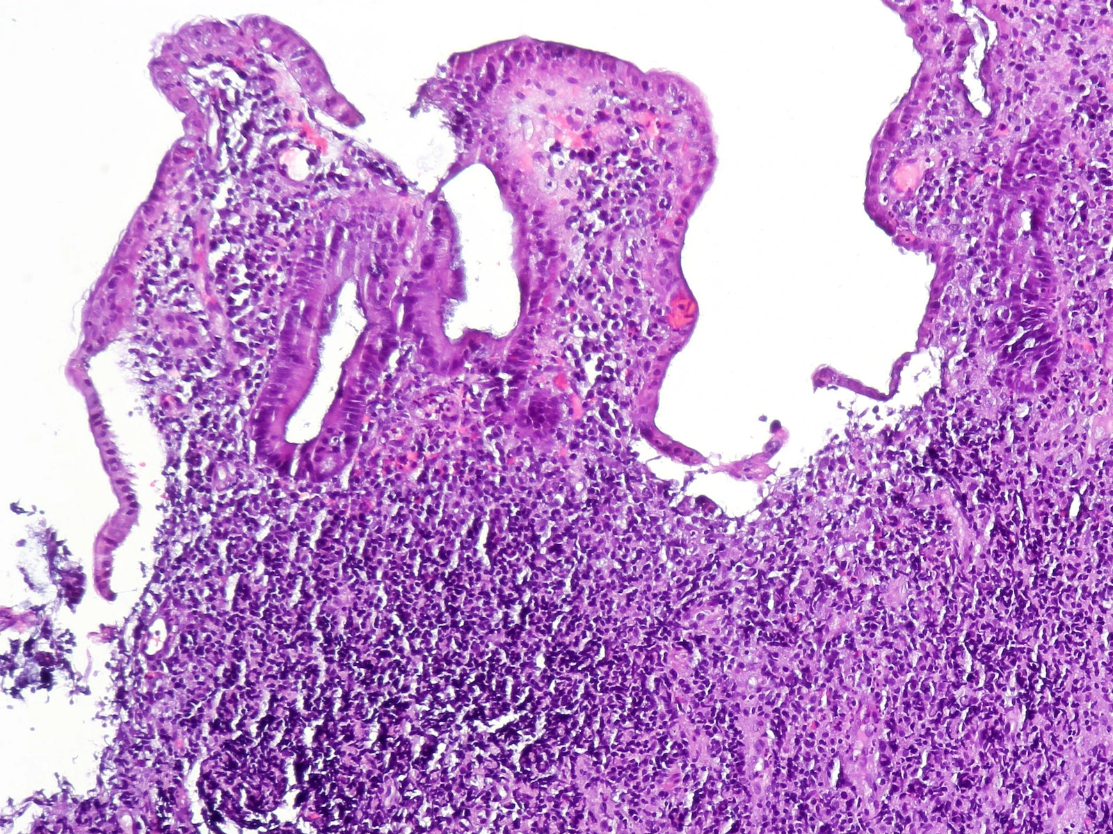 Colon mucosa with ulcerative colitis under the microscope: an irregular surface, a long, misshapen crypt and, below it, a mass of inflammatory cells