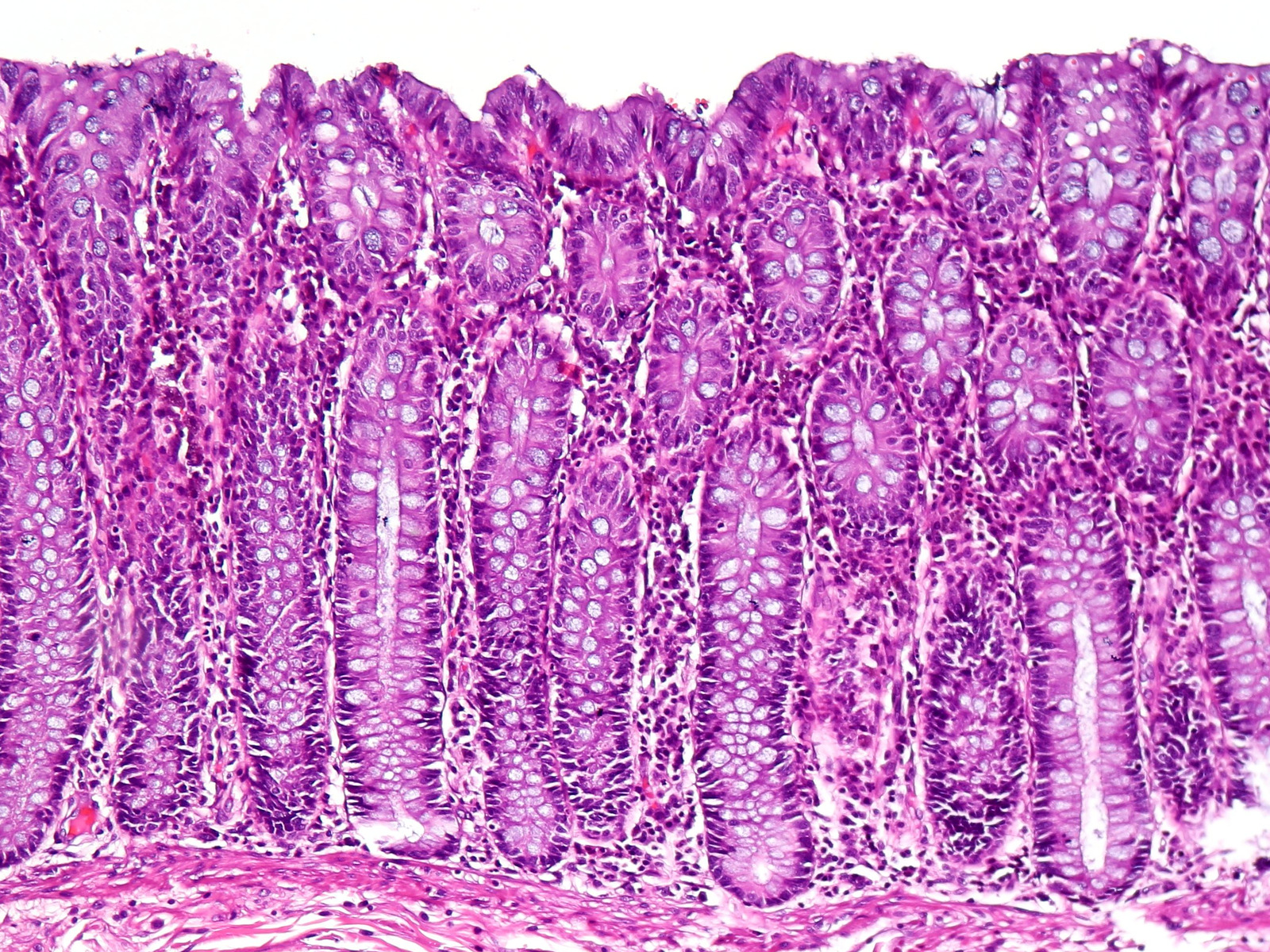 Visual journey cover: Crohn’s disease and ulcerative colitis: when the bowel is inflamed from within