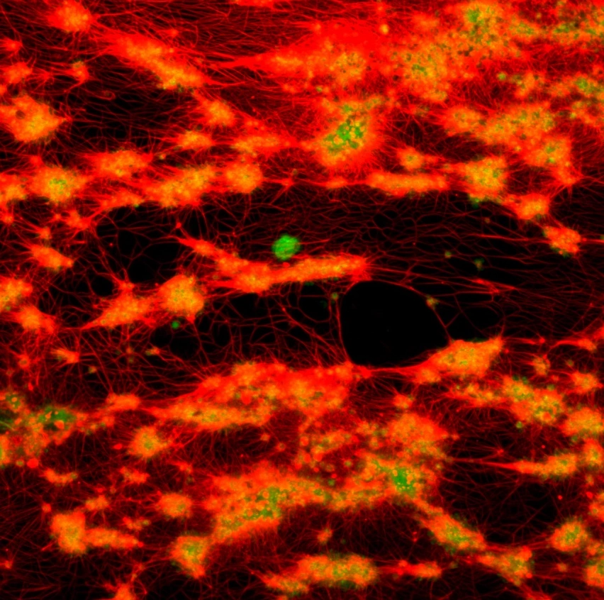 Confocal micrograph of a human blood clot: a mesh of red fibrin strands wraps around clusters of green platelets, which look yellow where they overlap with the red