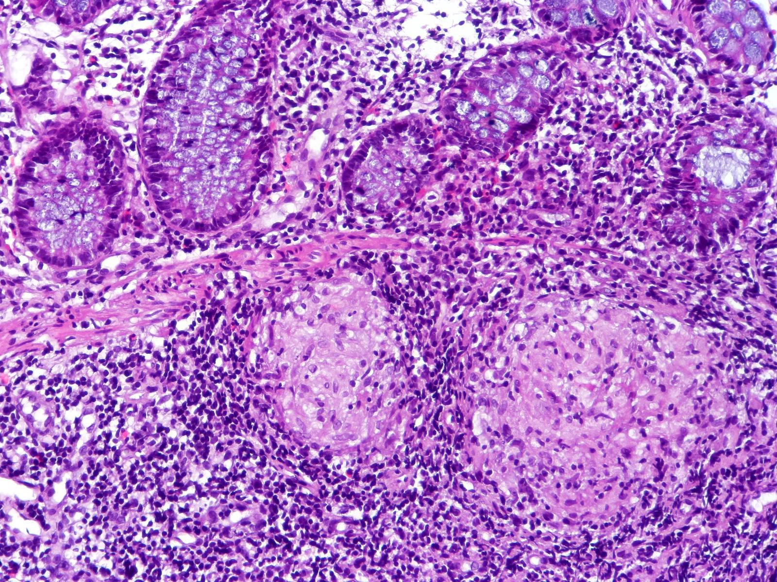 Colon biopsy with Crohn’s disease under the microscope: crypts cut crosswise at the top and, below them, two round, pale clusters of cells ringed by dark cells