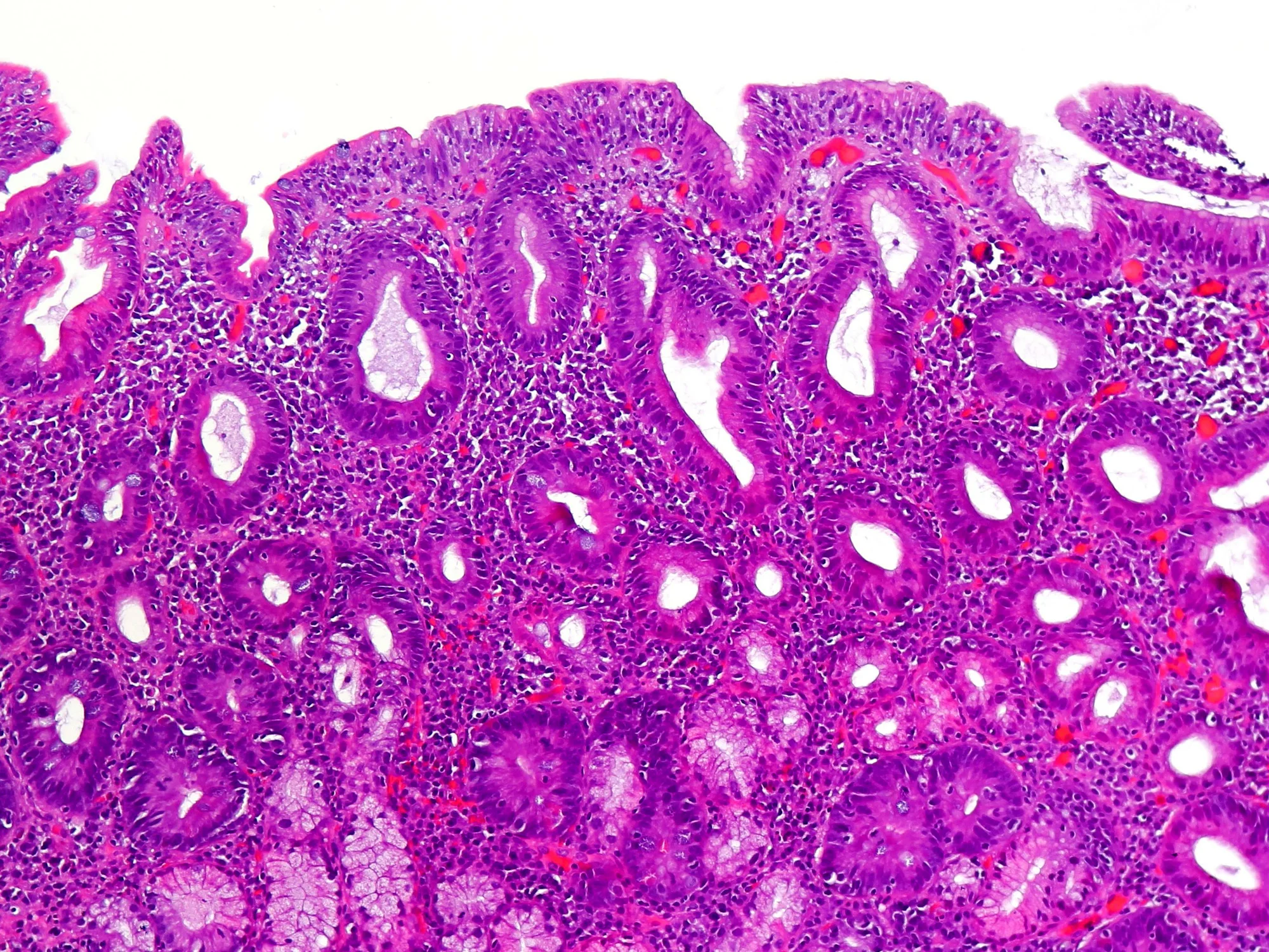 Duodenal biopsy from a person with celiac disease, stained with hematoxylin and eosin: an almost flat surface with no villi and elongated glands underneath