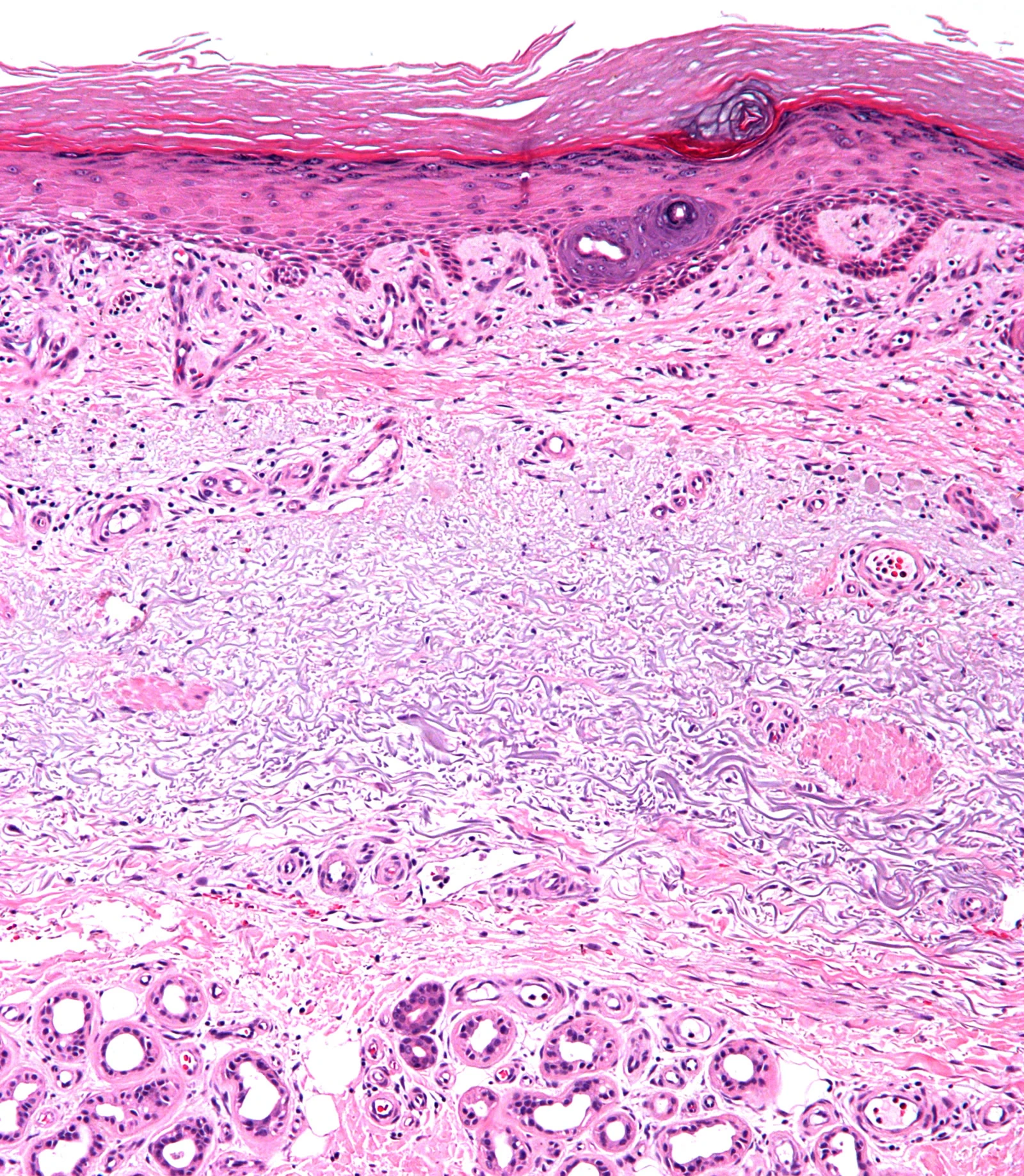 H&E micrograph of skin with solar elastosis, the damage that accumulated sun leaves in the dermis