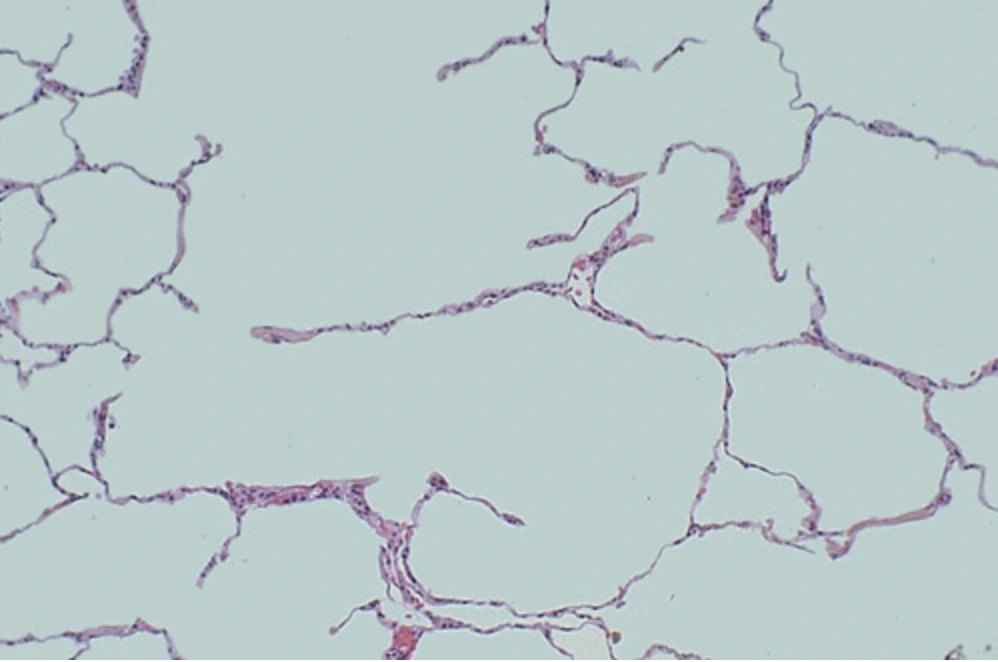 Human lung with emphysema and enlarged air spaces