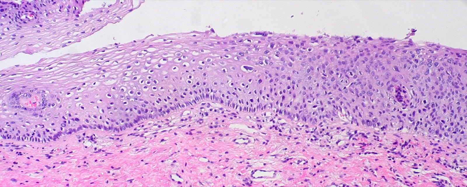 Cervical tissue under the microscope: the squamous epithelium shifts from pale and mature on the left to dark and crowded through nearly its full thickness on the right