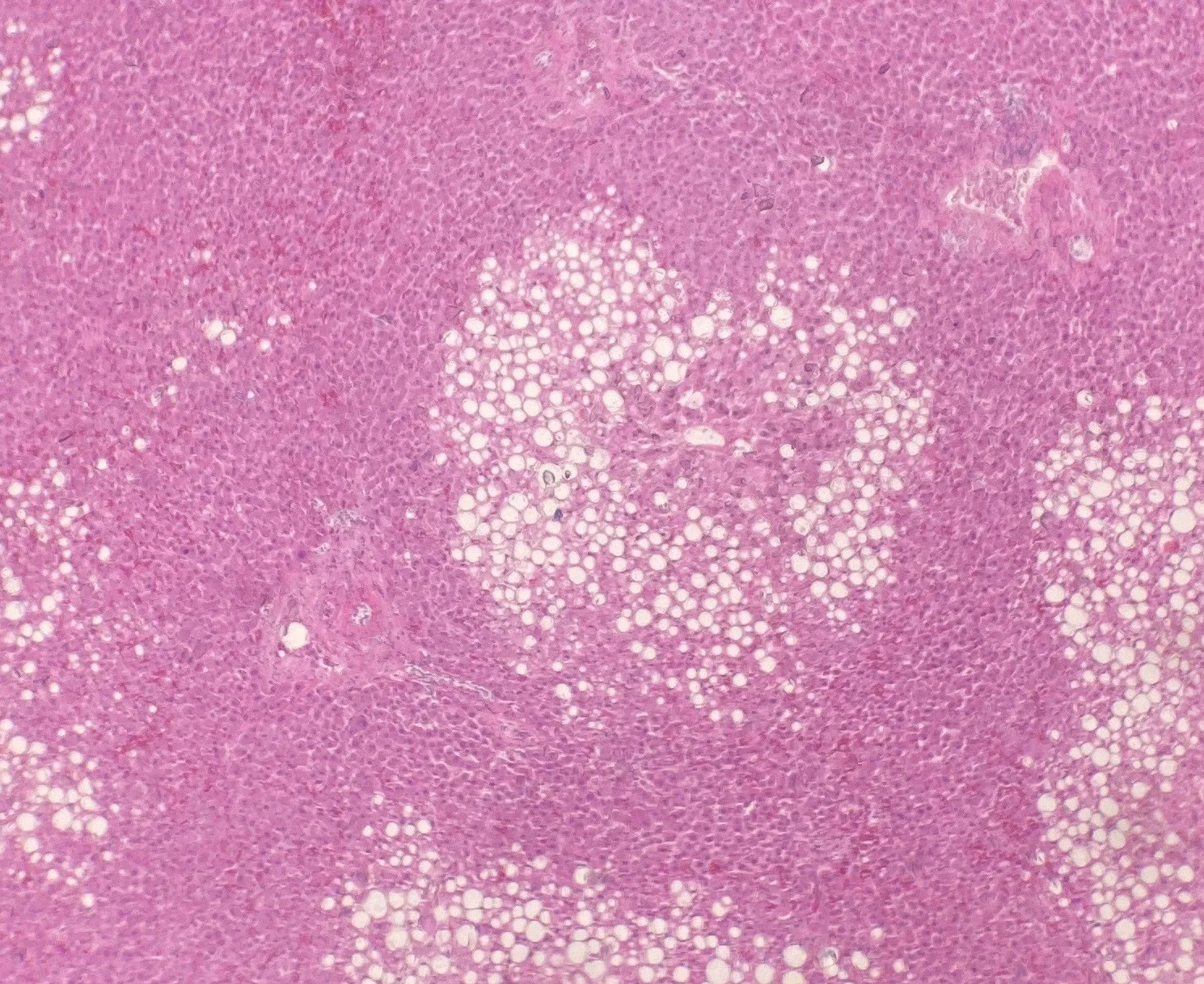 Micrograph of fatty liver: liver cells filled with clear fat droplets