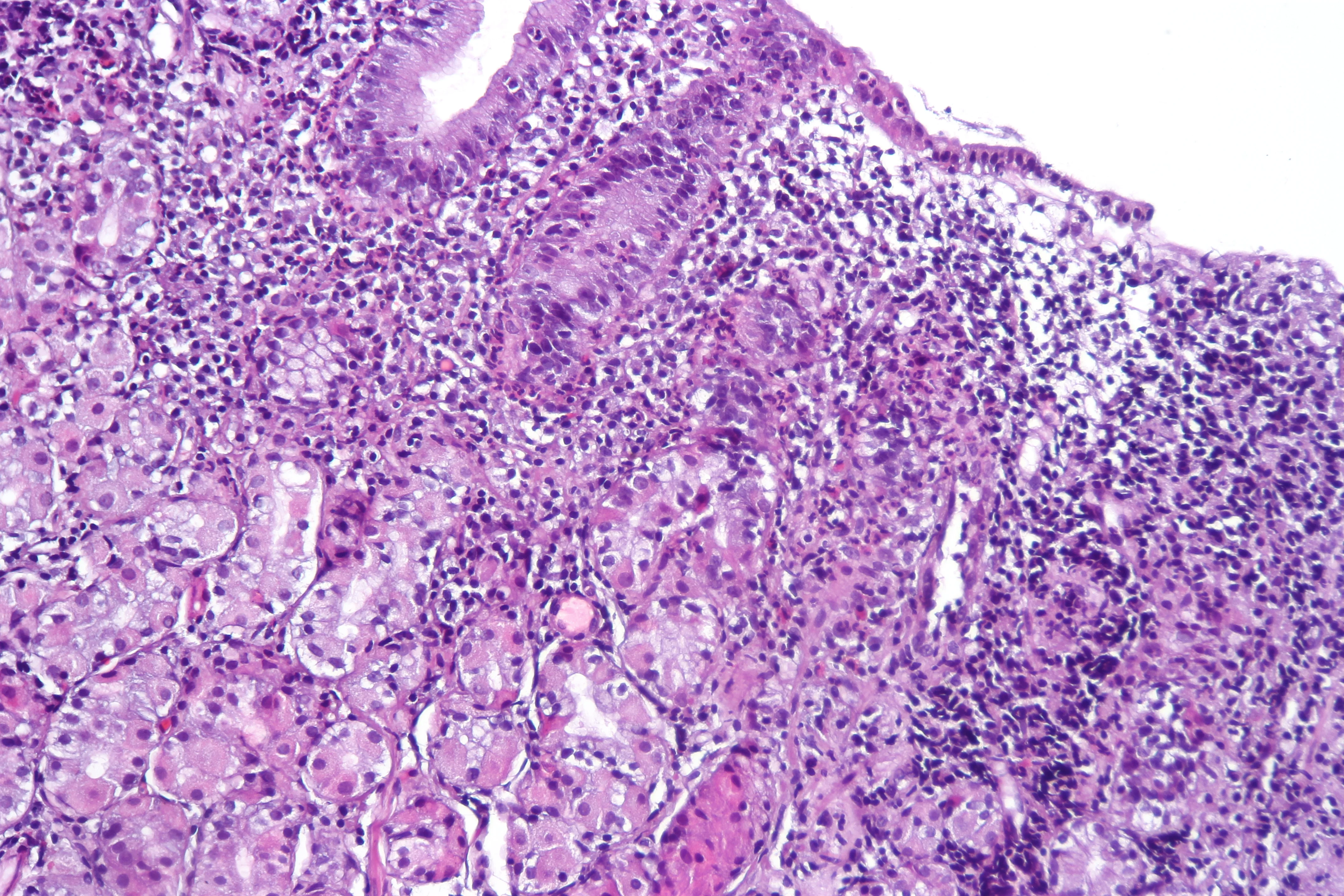 H&E micrograph of gastric mucosa with Helicobacter pylori-associated gastritis