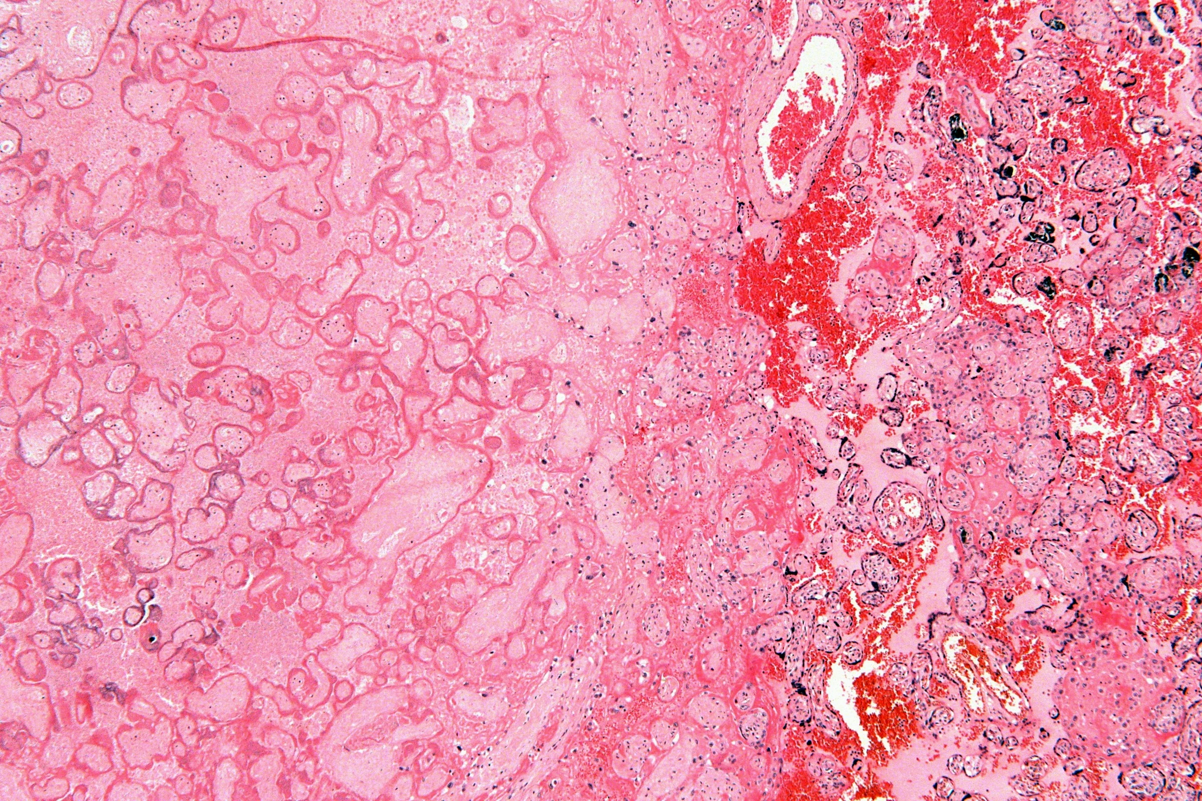 Placental infarct under the microscope: on the left, pale tissue with no blood between the villi; on the right, placenta with red blood between the villi