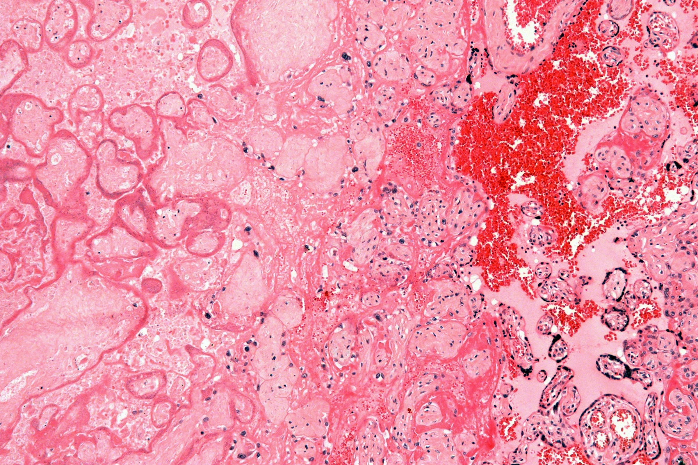 Placental infarct at higher magnification: pale villi that keep their outline but have lost their nuclei, next to villi with nuclei and blood