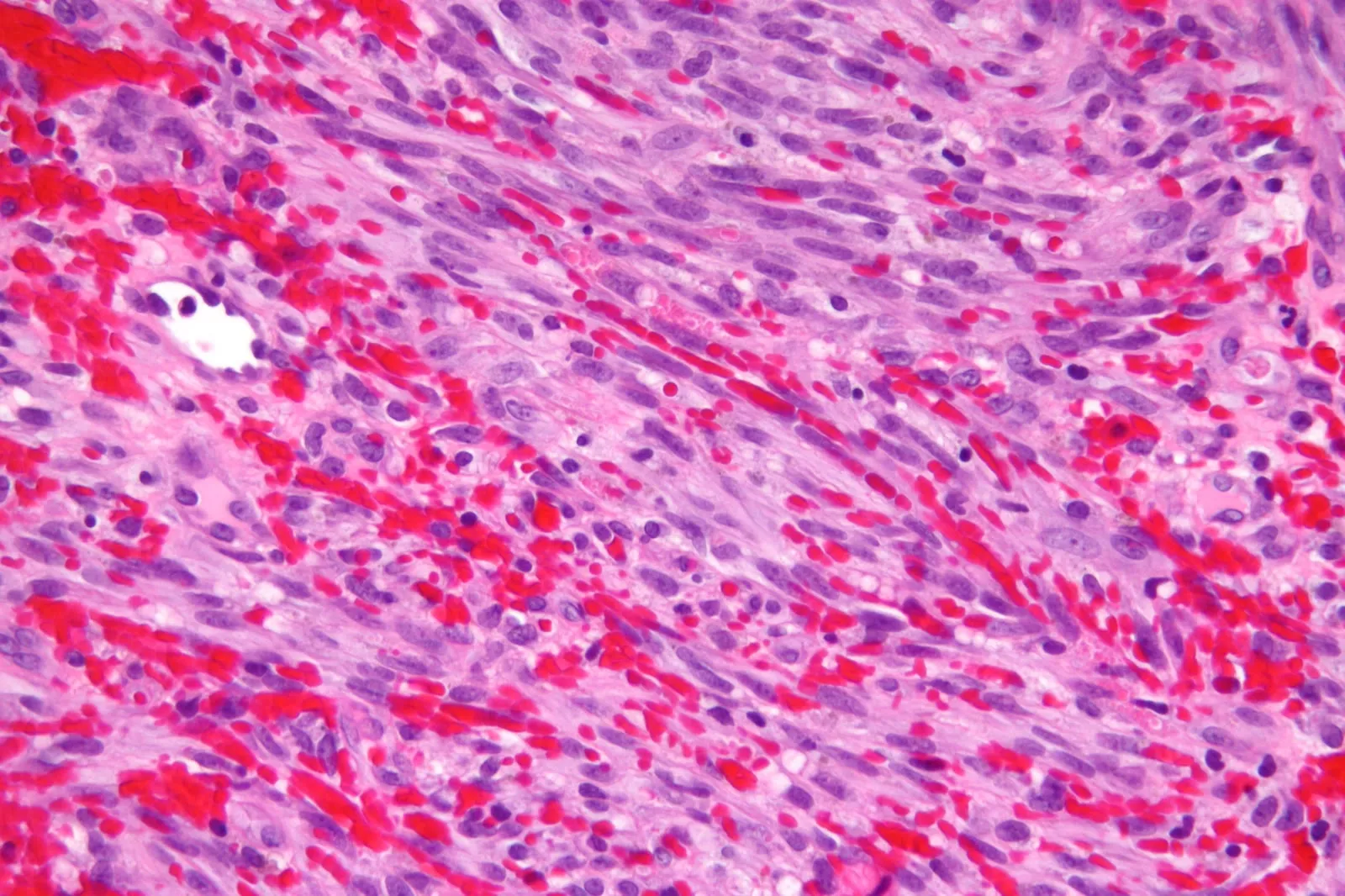 Micrograph of Kaposi sarcoma: spindle-shaped cells forming slit-like vascular spaces with red blood cells