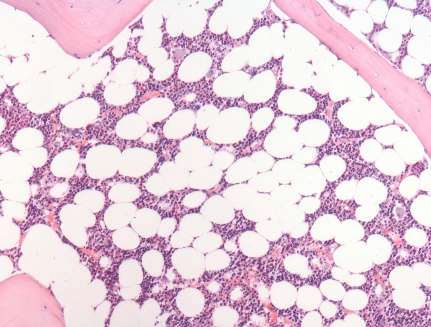Human bone marrow with purple hematopoietic tissue between adipocytes