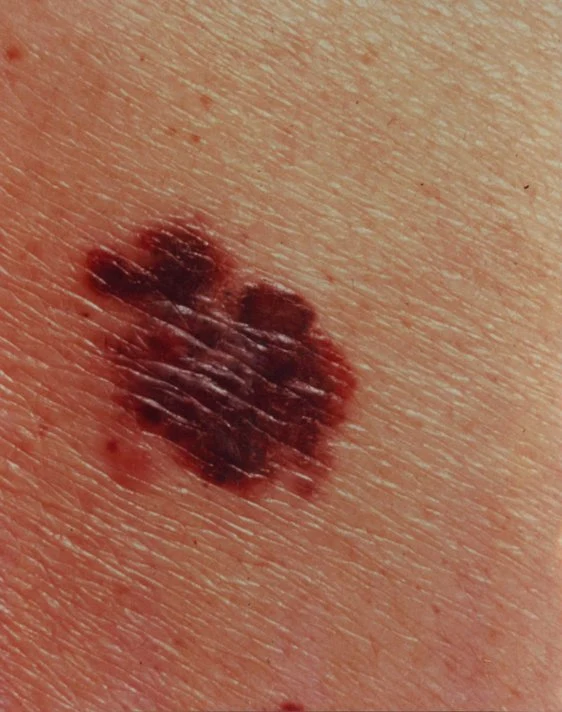 Melanoma with asymmetric shape, irregular borders, and color variation