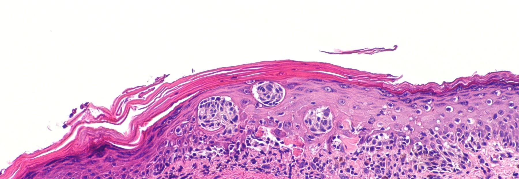 Melanoma in situ stained with H&E, with atypical melanocytes rising through the epidermis