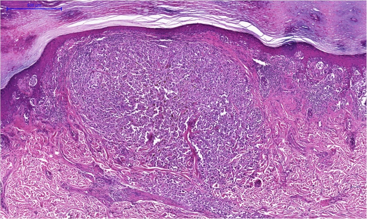 Invasive melanoma stained with H&E, with a nodule of tumor cells extending into the dermis