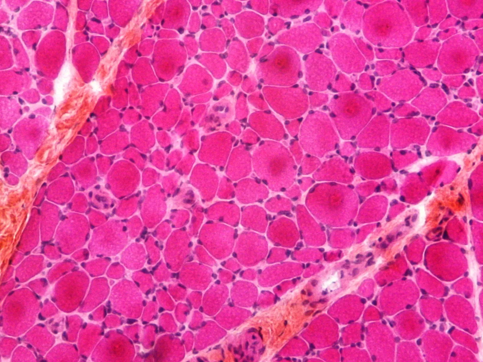 Muscle atrophy, a loss of muscle mass.