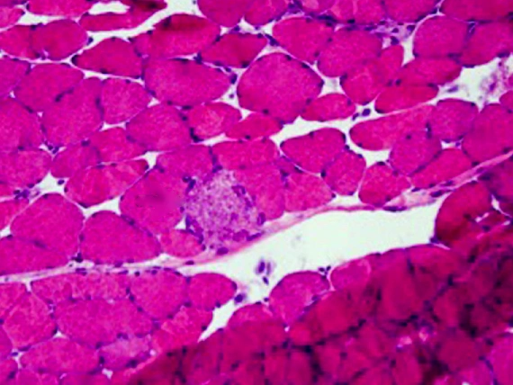 Muscle biopsy stained with hematoxylin and eosin: pink, polygonal fibers and, in the center, a pale, granular fiber marked as necrotic