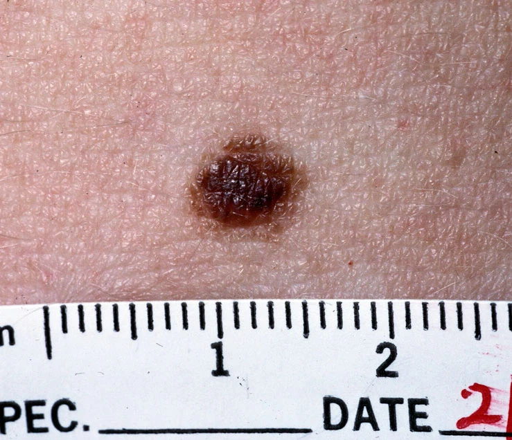 Benign mole that is round, symmetric, and uniform in color