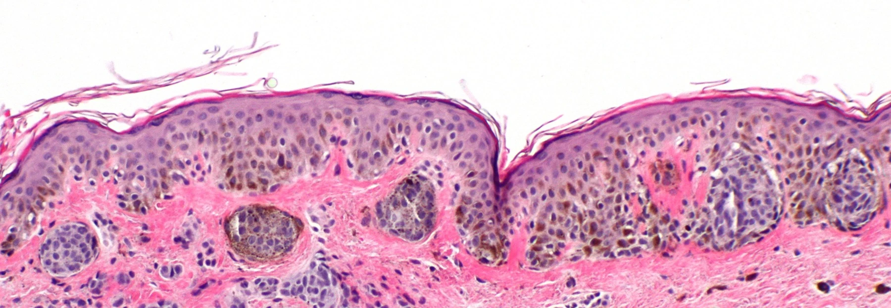 Compound nevus stained with H&E, with melanocyte nests grouped at the junction and in the dermis