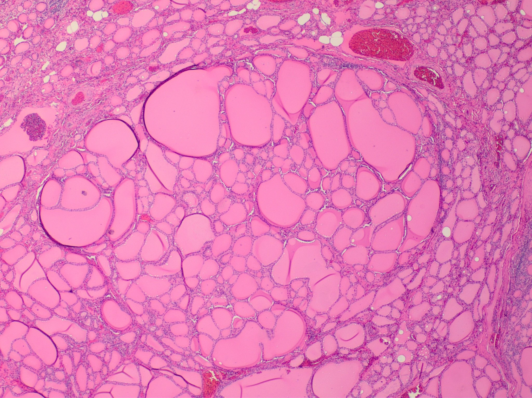 H&E micrograph of a benign hyperplastic thyroid nodule with follicles of varying sizes