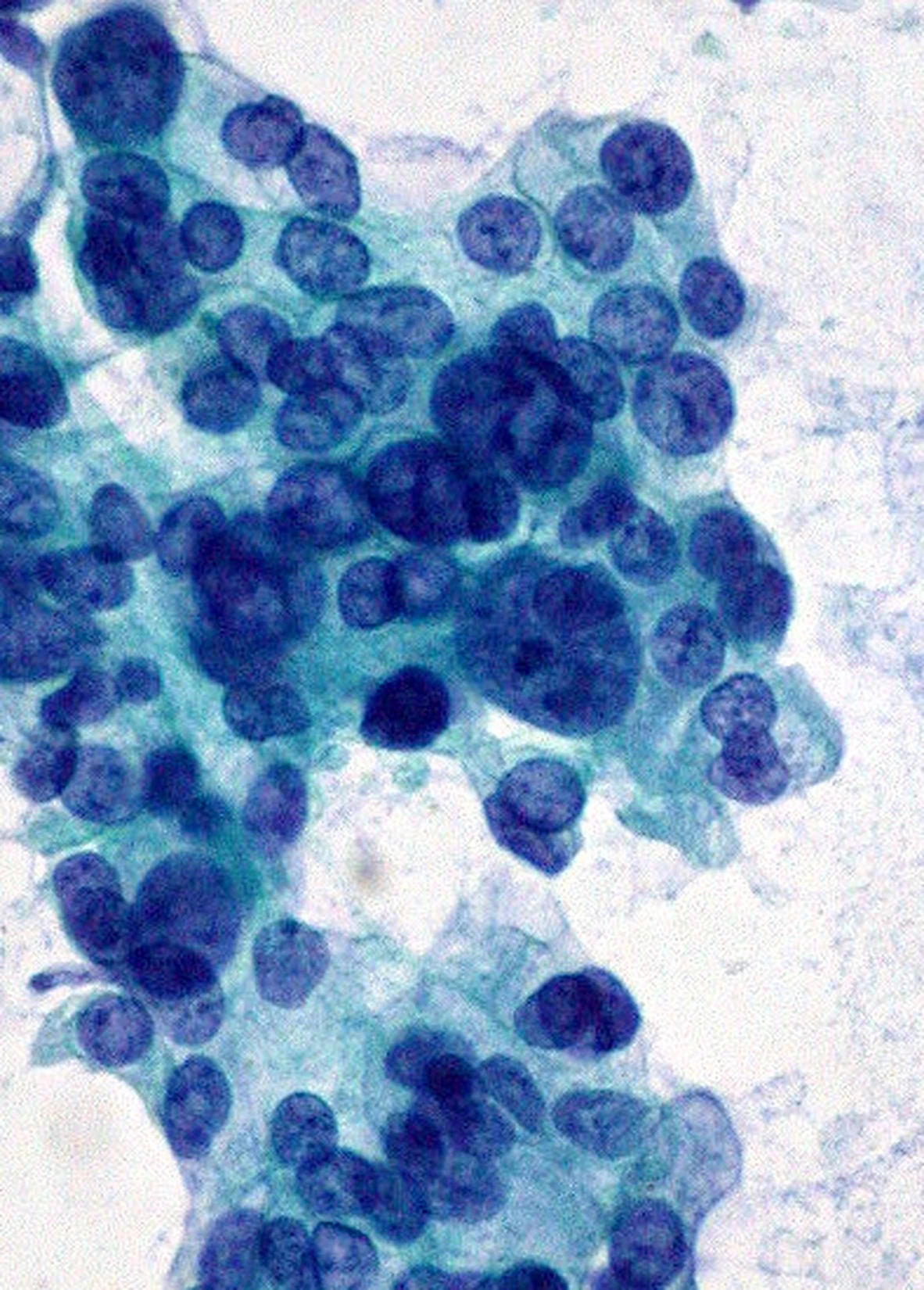 Pancreatic aspirate, stain not specified by the source: a crowded group of adenocarcinoma cells with large, uneven, overlapping nuclei and no even spacing
