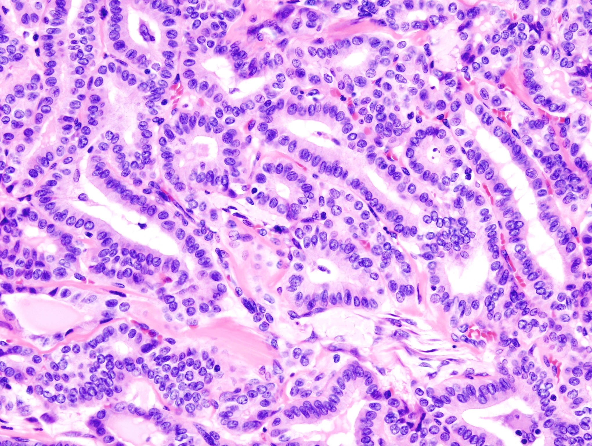 H&E micrograph of papillary thyroid carcinoma with crowded cells lining folds of tissue