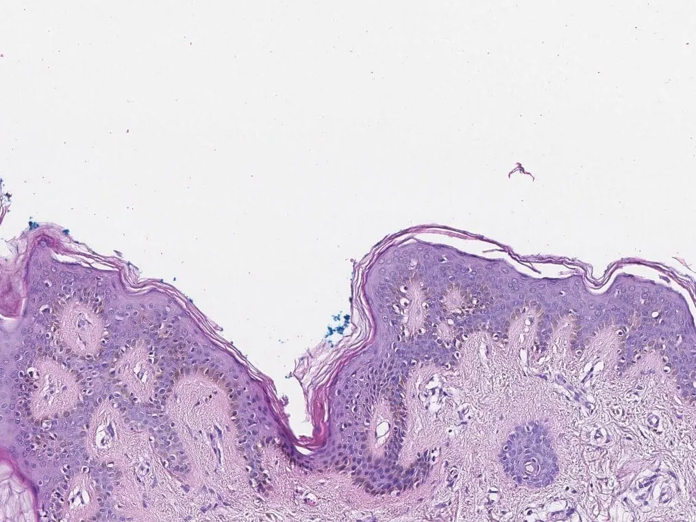 Normal skin under the microscope, with the epidermis on top and the dermis below, stained with H&E
