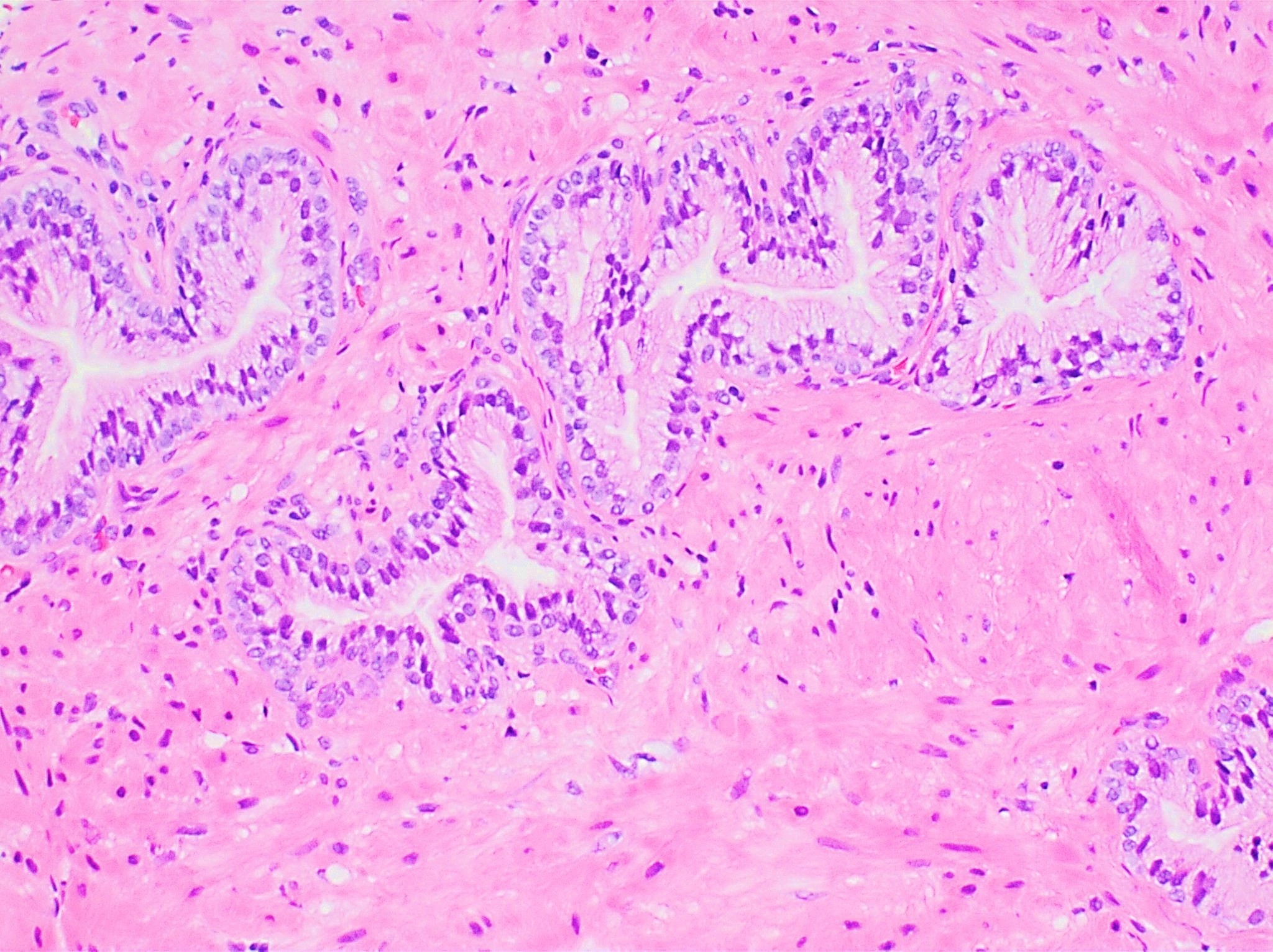 Normal prostate tissue: cells surrounding pale gland spaces, with supporting tissue between the glands.