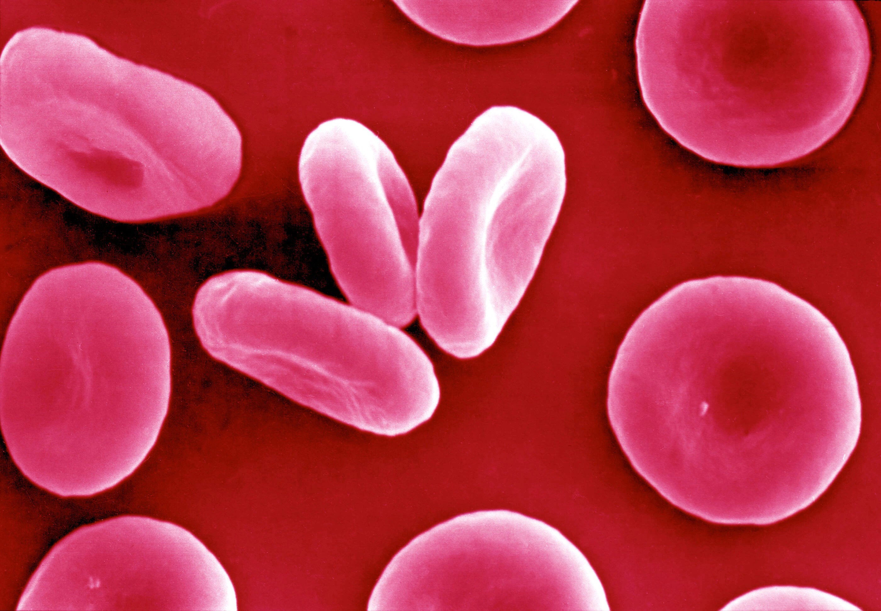Disc-shaped red blood cells with a dip in the center, shown in a colorized electron micrograph