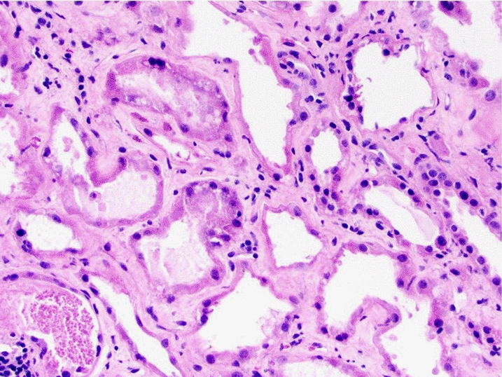 Kidney biopsy from a person with rhabdomyolysis, stained with hematoxylin and eosin: dilated, thin-walled tubules containing granular material