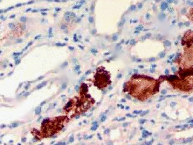 Immunohistochemical stain for myoglobin on the same kidney biopsy: brown-stained casts inside the tubules