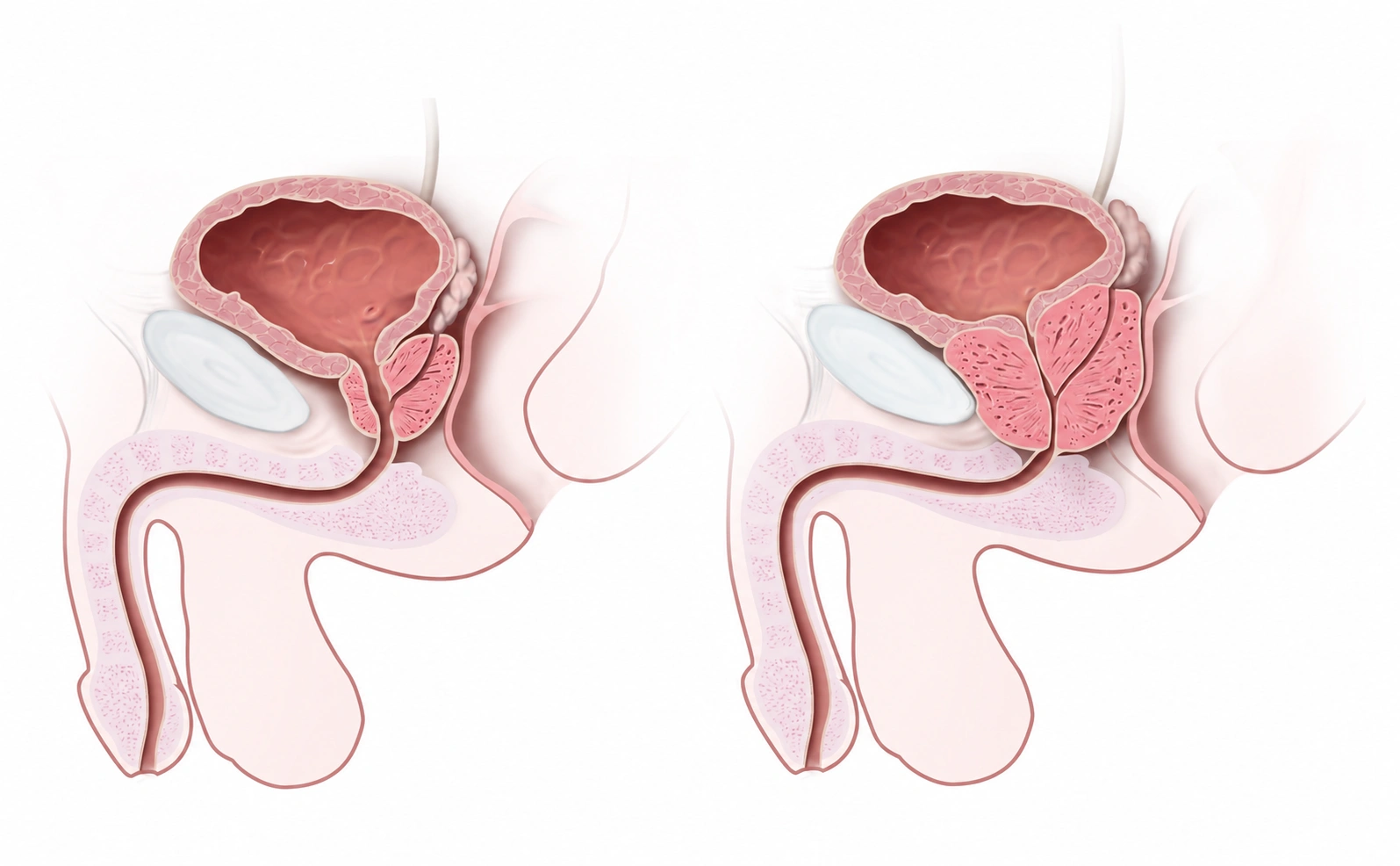 The prostate sits below the bladder; the urethra runs through it and continues through the penis.