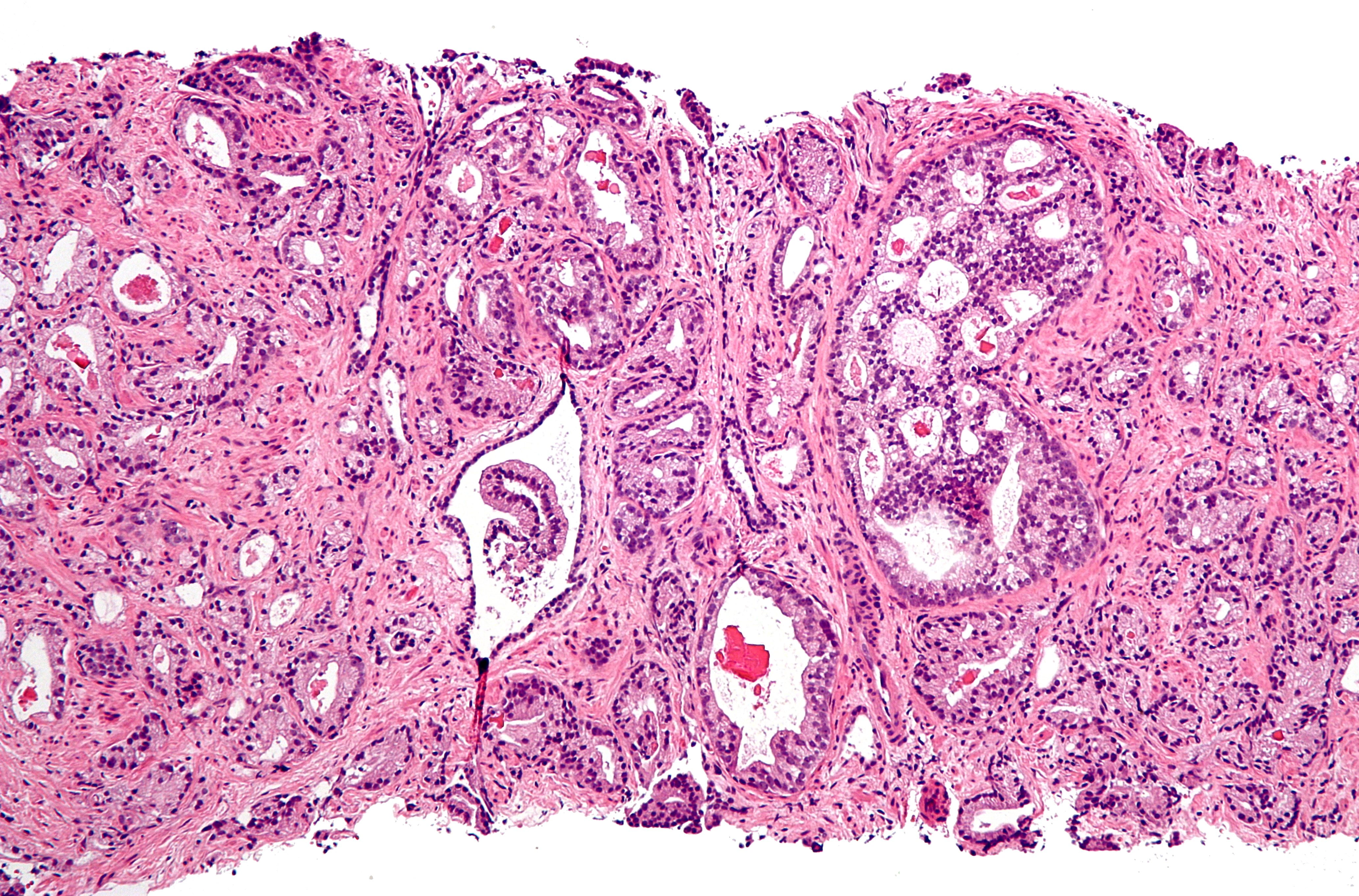 Prostate adenocarcinoma: several gland openings inside one continuous cluster of irregularly shaped glands.