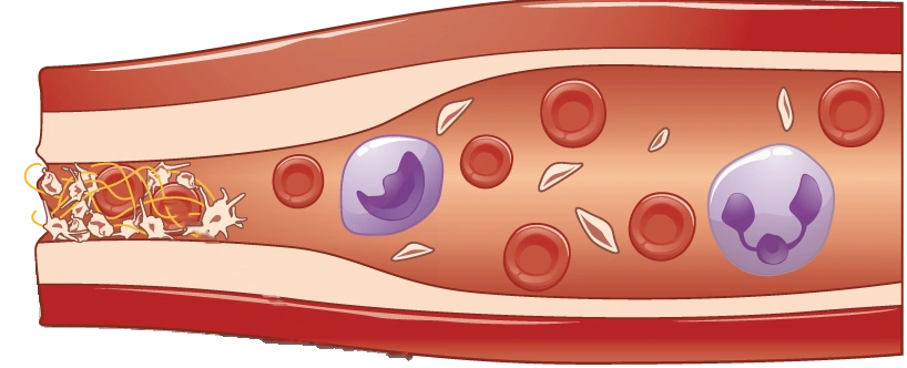 Ilustración del extremo de un vaso sellado por un tapón de plaquetas atravesado por hilos amarillos de fibrina que atrapan glóbulos rojos