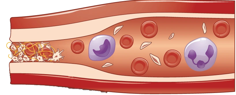 Illustration of the torn end of a blood vessel sealed by a plug of platelets laced with yellow strands of fibrin; red and white blood cells flow inside the vessel