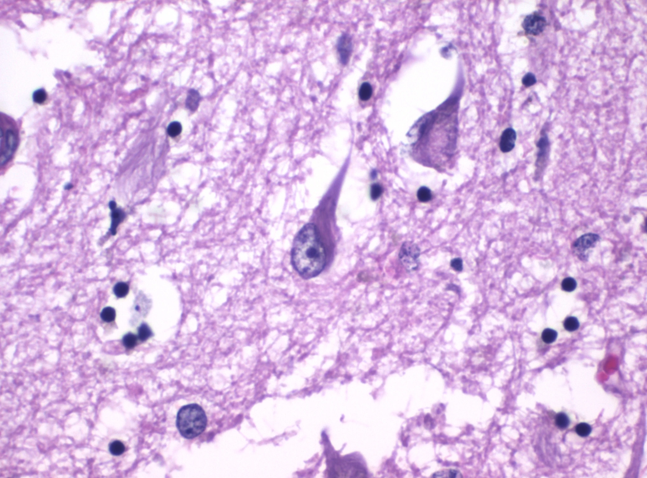H&E micrograph of neurofibrillary tangles in a hippocampus with Alzheimer’s disease